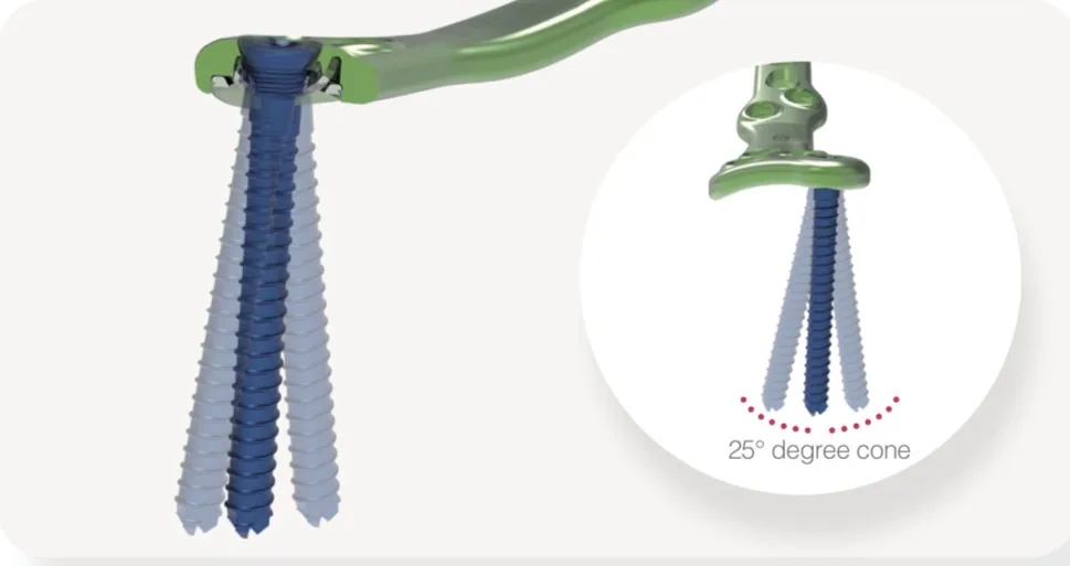 Polyaxial locking fixation - DTS System